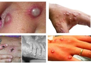 CDC hebt Reisewarnung für Affenpocken auf „Stufe 2“