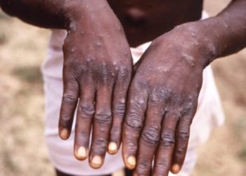 CDC ‘Follows The Science’ empfiehlt Masken für das nicht durch die Luft übertragene Affenpockenvirus